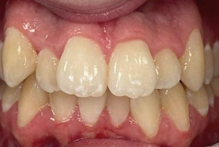 Invisalign Dd After